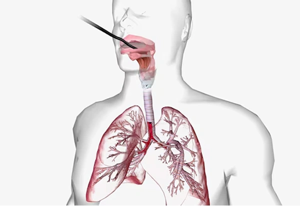 Bronchoscopy