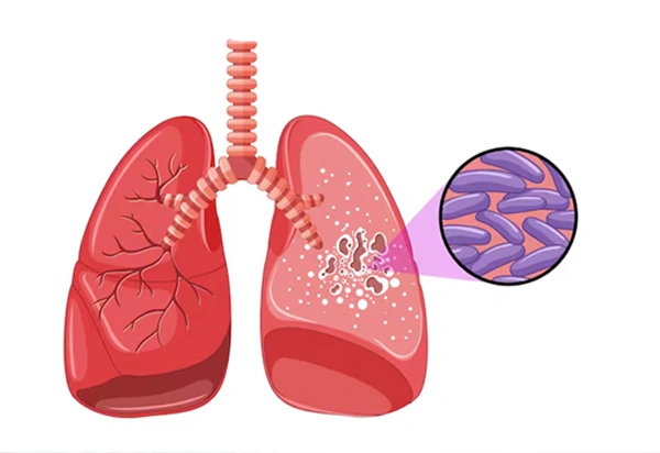 Tuberculosis and Lung Infection Management